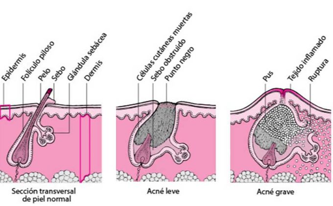 El Acné, Tratamiento, Síntomas Y Causas